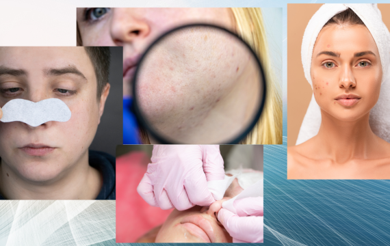 Комедони: природа утворення та засоби боротьби з ними