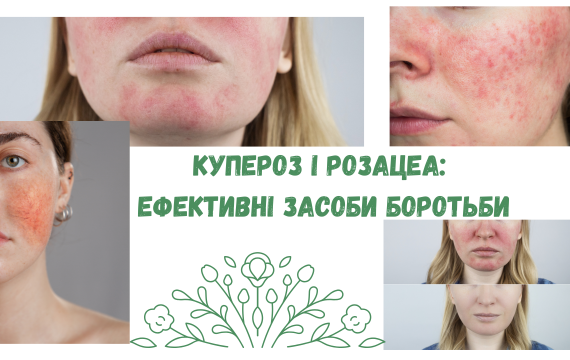 Купероз і розацеа: ефективні засоби боротьби Купероз і розацеа: ефективні засоби боротьби