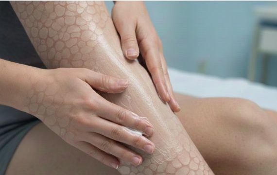 Іхтіоз: коли шкіра стає особливою