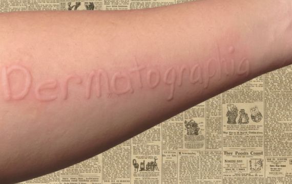 «Искусство рисовать на коже» или патология? Все о дермографизме и уходе за реактивной кожей
